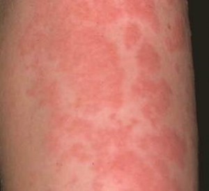 urticaria treinos academia